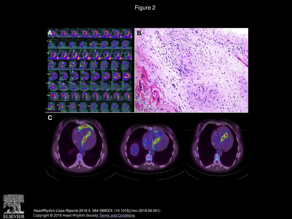 Lyme Disease And Cardiac Sarcoidosis Management Of Associated